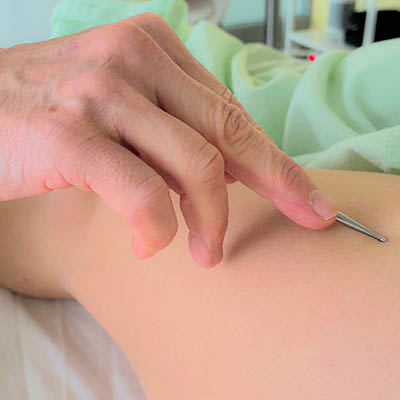Akupunktmassage